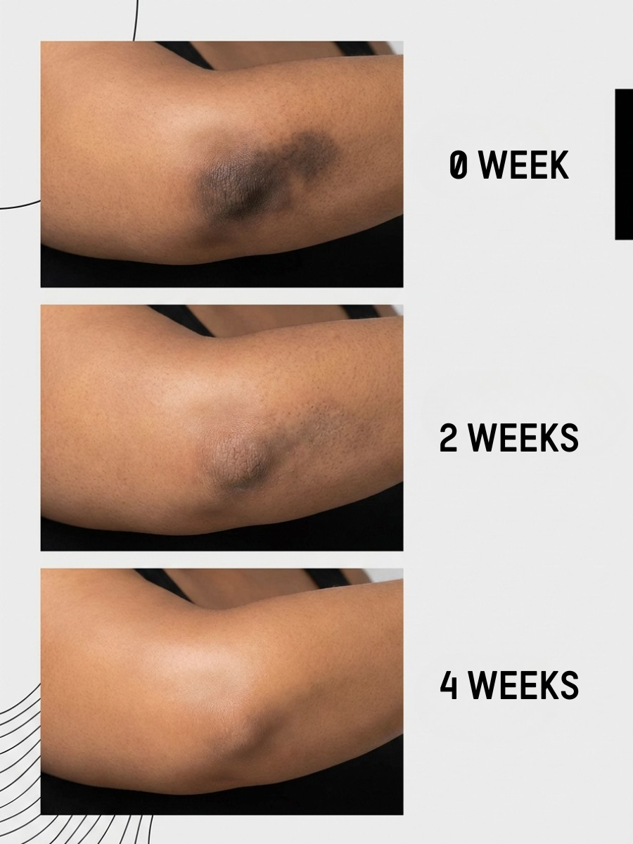 Uneven Skin Tone Eraser