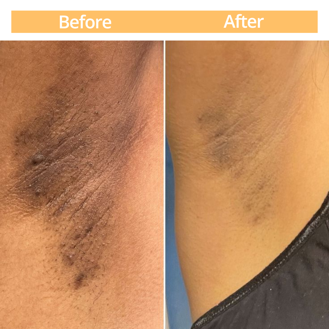 Sculpt Touch Peeling Gel-Removes Dark Legs and Armpits