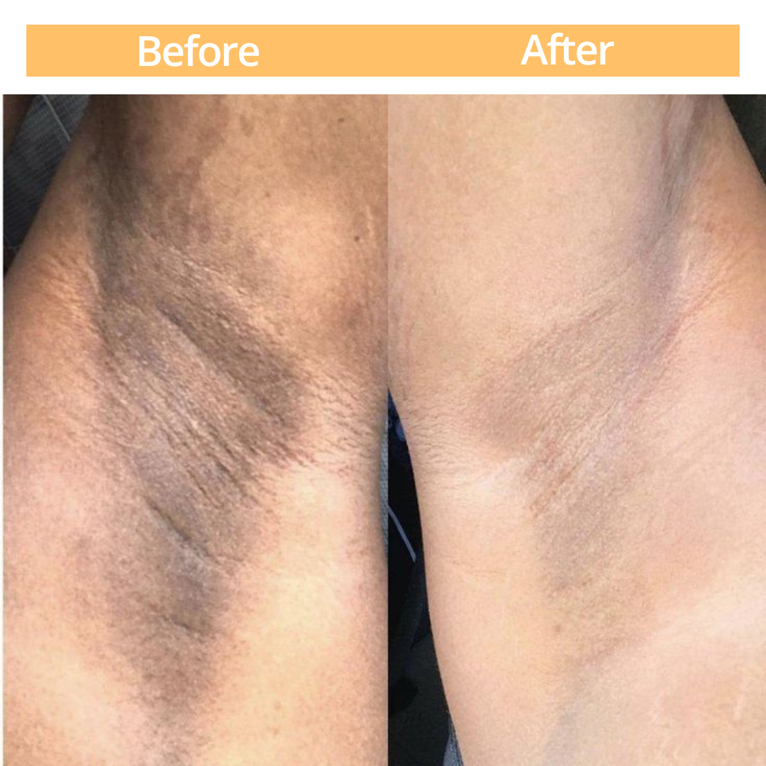Sculpt Touch Peeling Gel-Removes Dark Legs and Armpits
