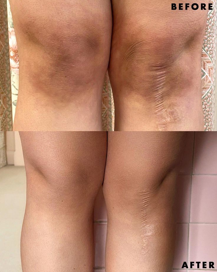 Sculpt Touch Peeling Gel-Removes Dark Legs and Armpits